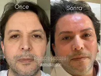 Nihat Doğan'ın Estetikli Yeni Hali Olay Oldu: Tanıyanlar Şaşkın!